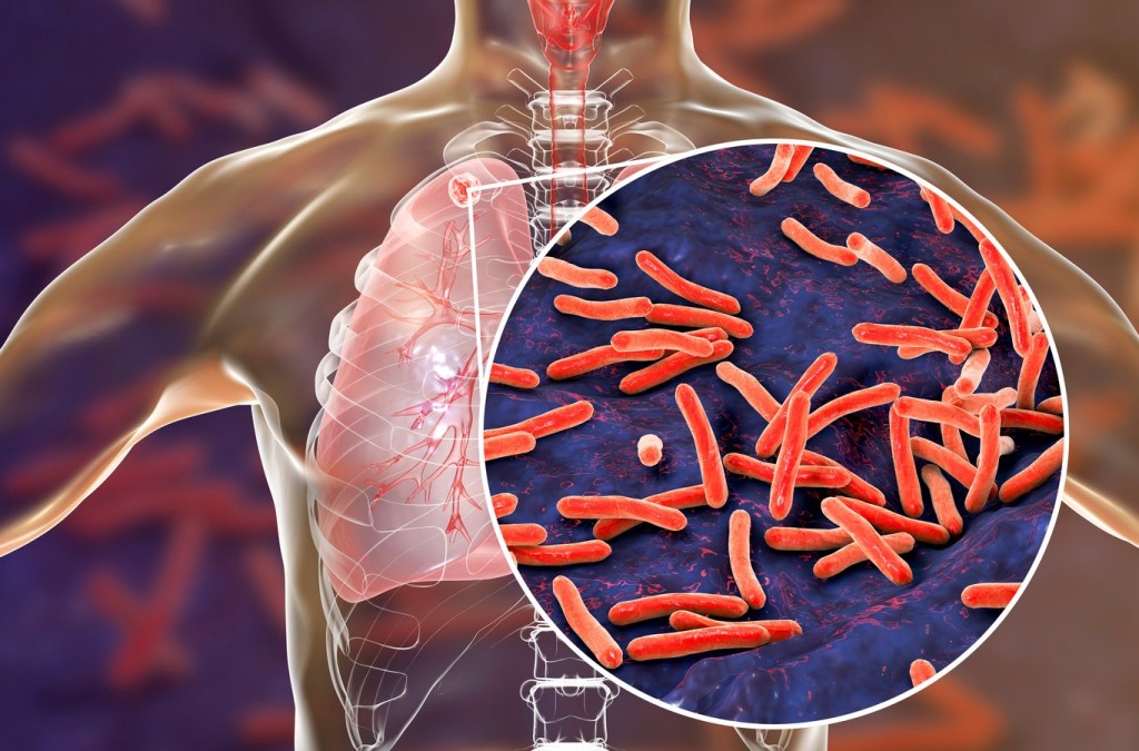 La tuberculosis provoca más de 11 mil nuevos casos en Argentina por año
